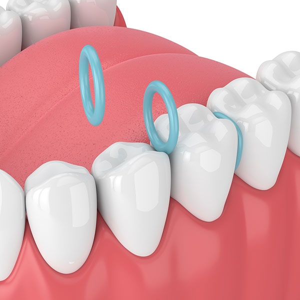 Round blue rings being placed between teeth.